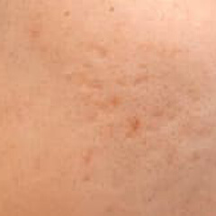 ニキビ跡クレーター