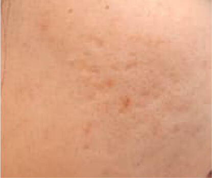 ニキビ跡クレーター