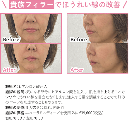 ほうれい線の改善