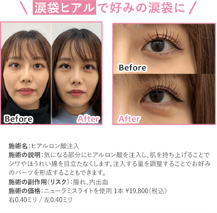 ほうれい線の改善