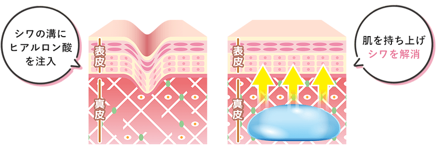 シワの溝にヒアルロン酸を注入 肌を持ち上げシワを解消