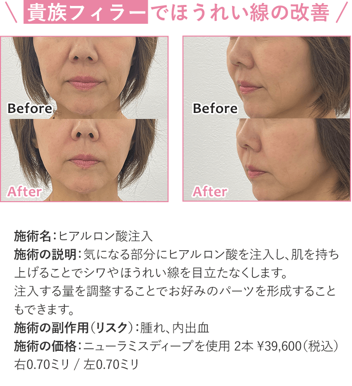 ほうれい線の改善