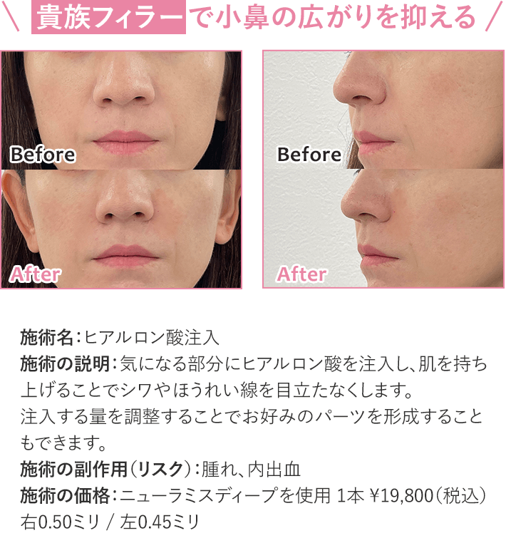 小鼻の広がりを抑える