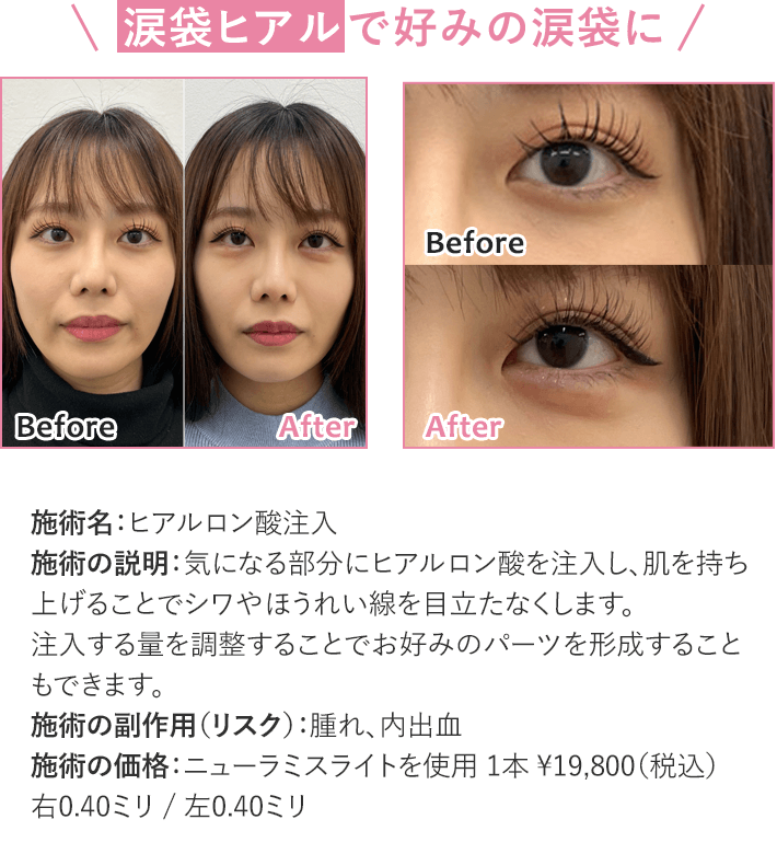 切らずに中顔面短縮 好みの涙袋に