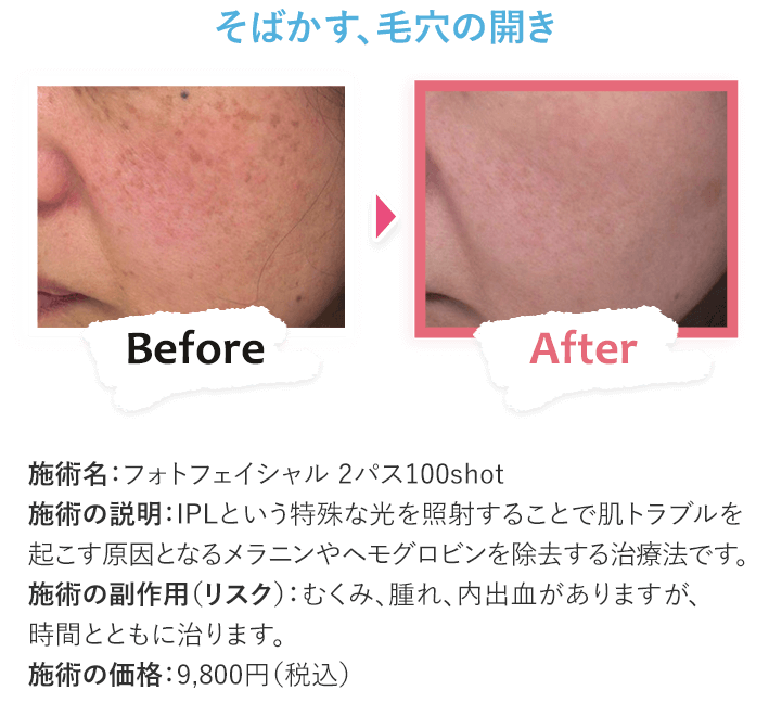 そばかす、毛穴の開き