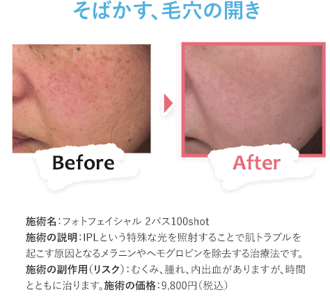 そばかす、毛穴の開き